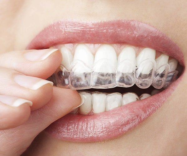 Clear Dental Aligners Carrollton TX - Invisible Teeth Straightening
